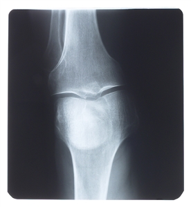 Diet 'plays key role in bone development'