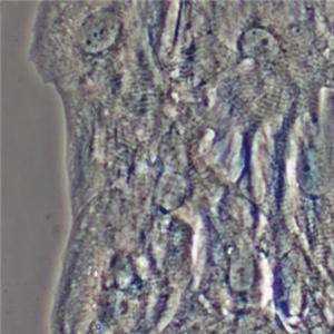 Heart attack patients may benefit from stem cell treatment