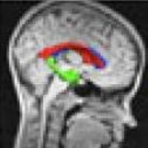 Hospital doctors 'could use brain scan to diagnose autism'