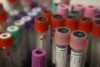 Blood test to predict...