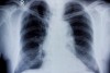 Lung cancer tumours 'differ in...