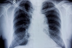 Breath test could provide a more effiecient test for conditions such as tuberculosis. Current tests for bacteria can take weeks to yield results. Infections of the lungs, such as tuberculosis, could soon be diagnosed by using a test that analyses the smel