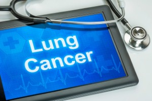 Alectinib has been approved by NICE for NHS use as a treatment of ALK-positive advanced non-small cell lung cancer.