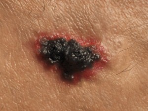A melanoma drug designed to help people whose cancer has spread to the lymph nodes should be available on the NHS next month after it was approved for use.